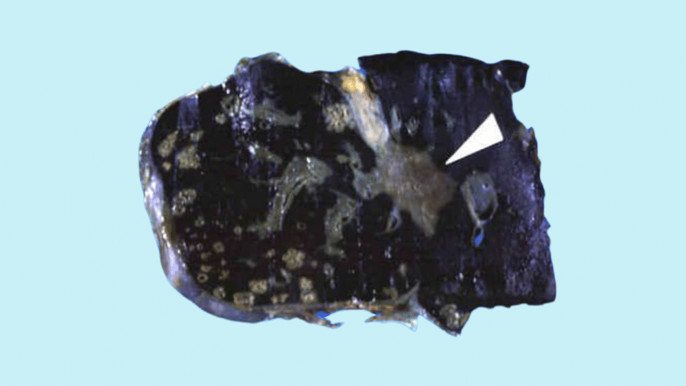 Black Iron Over Loaded Liver