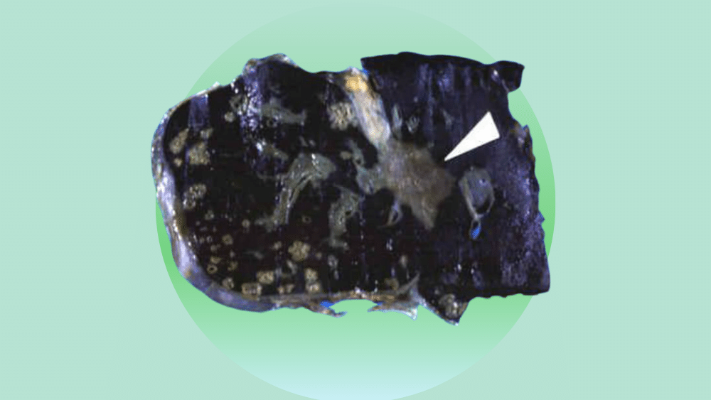 Iron overload in horses
